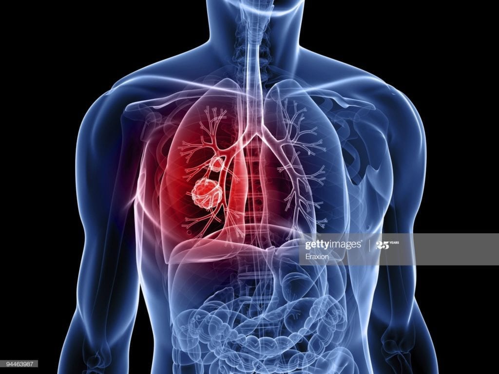 Lung Cancer Diagnosis Treatment Central Georgia Cancer Care in